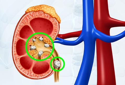 Nga se krijohen gurët në veshka?